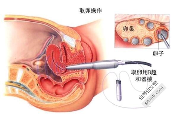 江苏南京做第三代代生子技术费用贵吗？